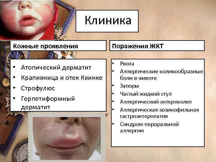 Клиника Кожные проявления • • Атопический дерматит Крапивница и отек Квинке Строфулюс Герпетиформный дерматит