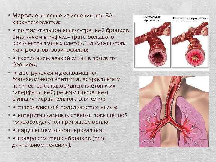  • Морфологические изменения при БА характеризуются: • • воспалительной инфильтрацией бронхов с наличием