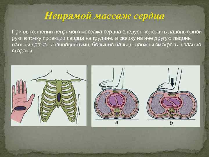 Непрямой массаж сердца При выполнении непрямого массажа сердца следует положить ладонь одной руки в