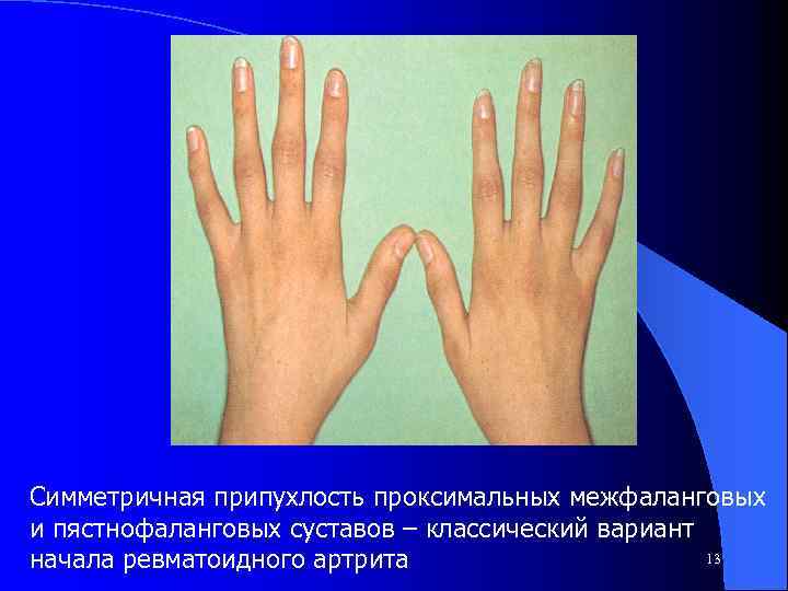 Симметричная припухлость проксимальных межфаланговых и пястнофаланговых суставов – классический вариант 13 начала ревматоидного артрита