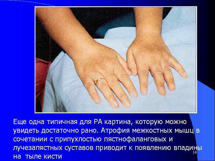 Еще одна типичная для РА картина, которую можно увидеть достаточно рано. Атрофия межкостных мышц