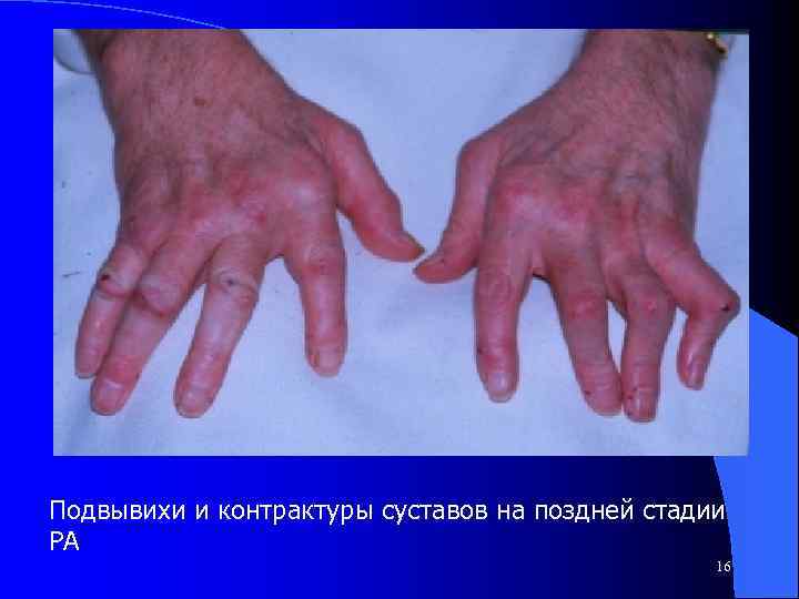 Подвывихи и контрактуры суставов на поздней стадии РА 16 