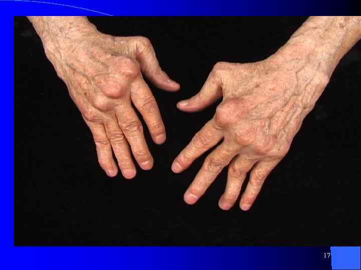 Поэтому с практической точки зрения поражение суставов и околосуставных мягких тканей при РА удобнее