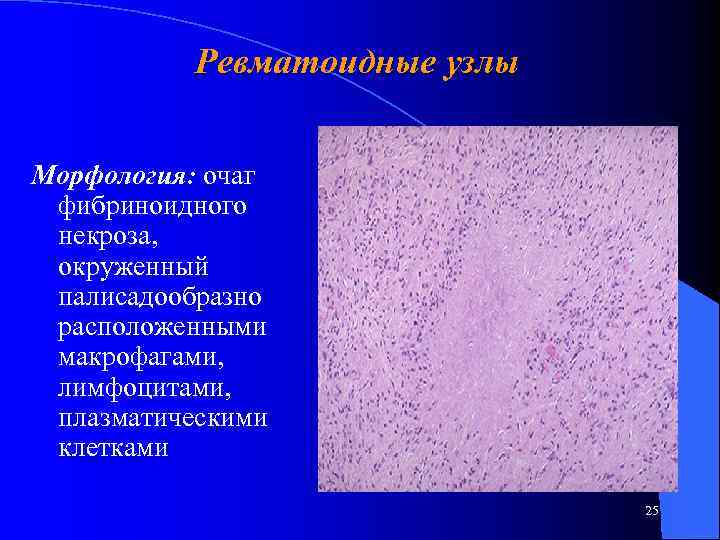 Ревматоидные узлы Морфология: очаг фибриноидного некроза, окруженный палисадообразно расположенными макрофагами, лимфоцитами, плазматическими клетками 25