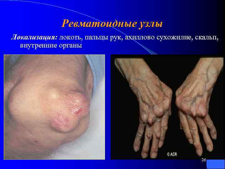 Ревматоидные узлы Локализация: локоть, пальцы рук, ахиллово сухожилие, скальп, внутренние органы 26 