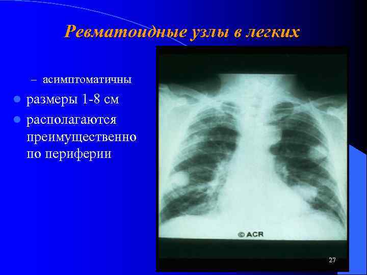 Ревматоидные узлы в легких – асимптоматичны размеры 1 -8 см l располагаются преимущественно по