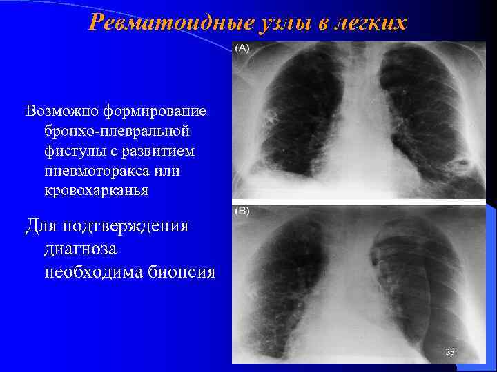Ревматоидные узлы в легких Возможно формирование бронхо-плевральной фистулы с развитием пневмоторакса или кровохарканья Для