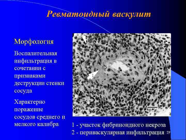 Ревматоидный васкулит Морфология Воспалительная инфильтрация в сочетании с признаками деструкции стенки сосуда 2 1