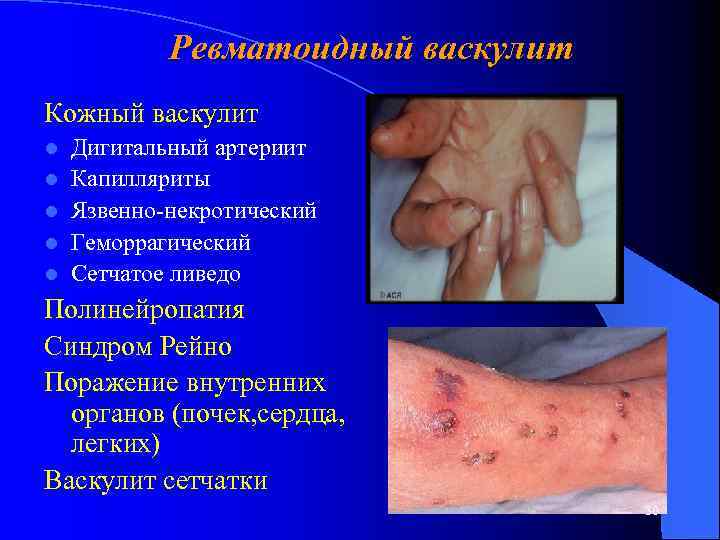 Ревматоидный васкулит Кожный васкулит l l l Дигитальный артериит Капилляриты Язвенно-некротический Геморрагический Сетчатое ливедо
