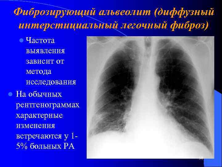 Фиброзирующий альвеолит (диффузный интерстициальный легочный фиброз) l Частота выявления зависит от метода исследования l
