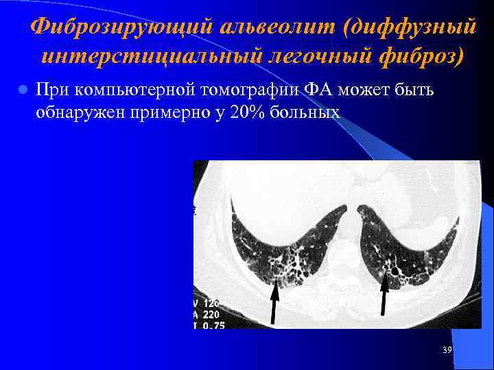 Фиброзирующий альвеолит (диффузный интерстициальный легочный фиброз) l При компьютерной томографии ФА может быть обнаружен