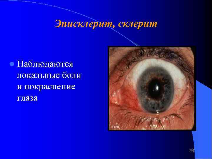 Эписклерит, склерит l Наблюдаются локальные боли и покраснение глаза 44 