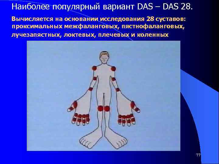 Наиболее популярный вариант DAS – DAS 28. Вычисляется на основании исследования 28 суставов: проксимальных