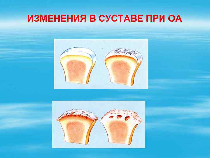 ИЗМЕНЕНИЯ В СУСТАВЕ ПРИ ОА 