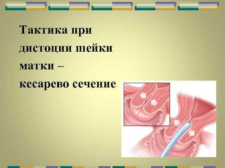Тактика при дистоции шейки матки – кесарево сечение 