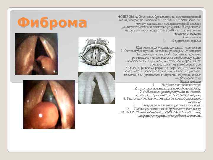 Фиброма ФИБРОМА. Это новообразование из соединительной ткани, покрытое плоским эпителием. От соотношения между клетками