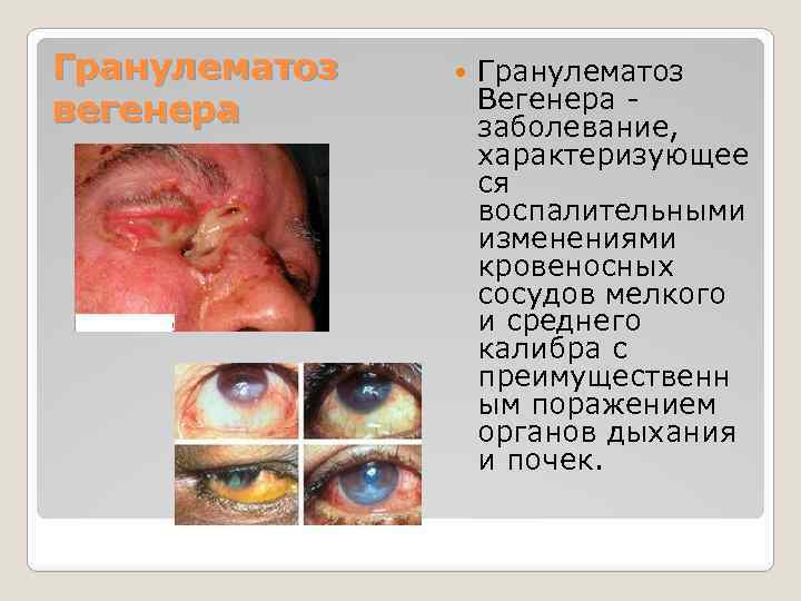 Гранулематоз вегенера Гранулематоз Вегенера - заболевание, характеризующее ся воспалительными изменениями кровеносных сосудов мелкого и