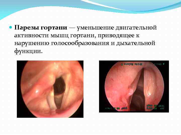  Парезы гортани — уменьшение двигательной активности мышц гортани, приводящее к нарушению голосообразования и