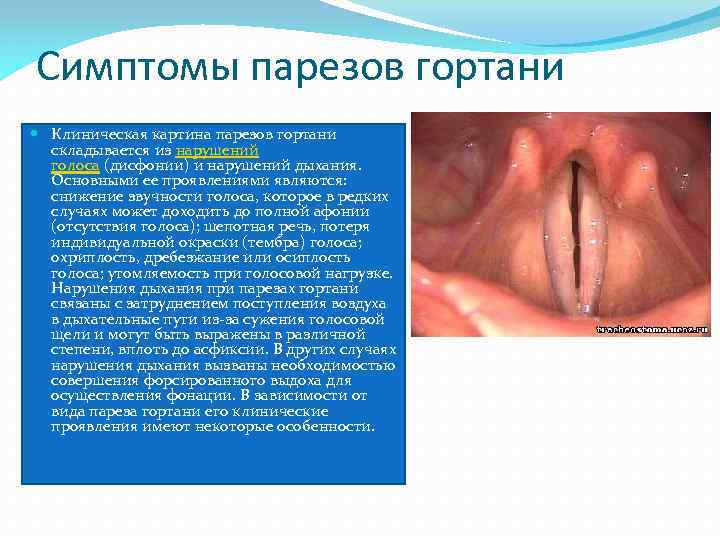 Симптомы парезов гортани Клиническая картина парезов гортани складывается из нарушений голоса (дисфонии) и нарушений