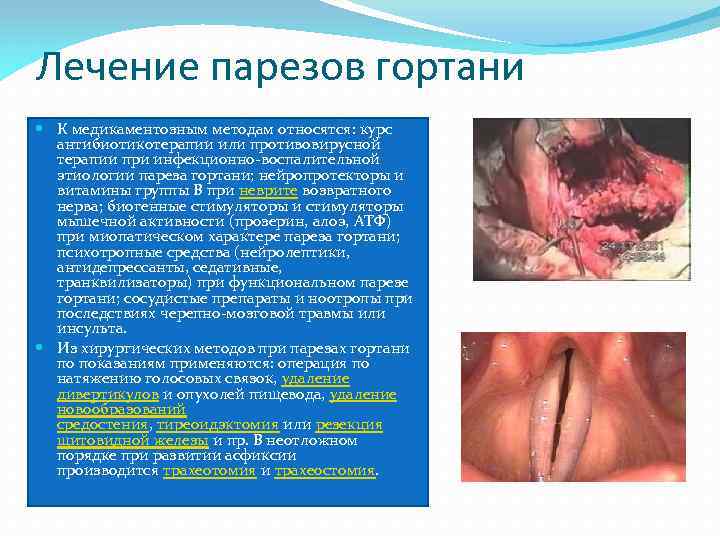 Лечение парезов гортани К медикаментозным методам относятся: курс антибиотикотерапии или противовирусной терапии при инфекционно-воспалительной