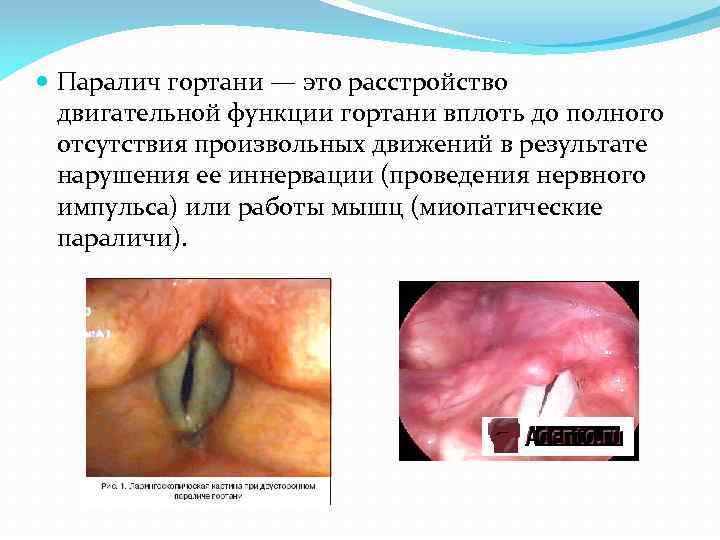  Паралич гортани — это расстройство двигательной функции гортани вплоть до полного отсутствия произвольных