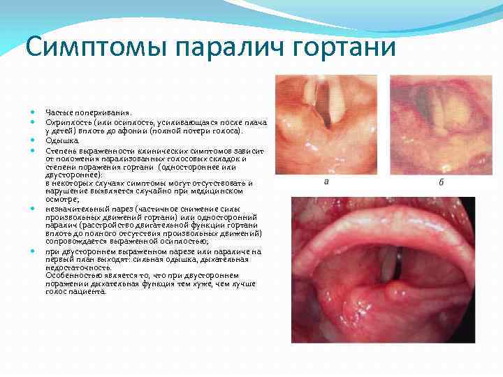 Симптомы паралич гортани Частые поперхивания. Охриплость (или осиплость, усиливающаяся после плача у детей) вплоть