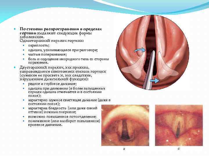  По степени распространения в пределах гортани выделяют следующие формы заболевания. Односторонний паралич гортани: