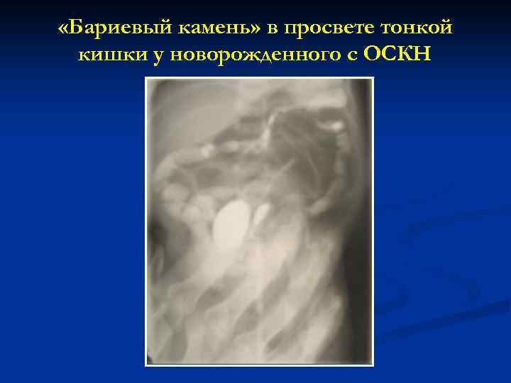  «Бариевый камень» в просвете тонкой кишки у новорожденного с ОСКН 