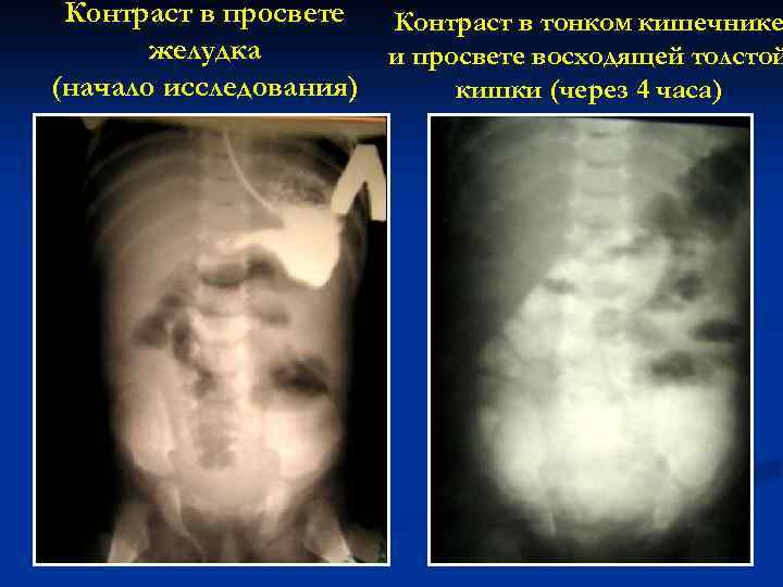 Контраст в просвете Контраст в тонком кишечнике желудка и просвете восходящей толстой (начало исследования)