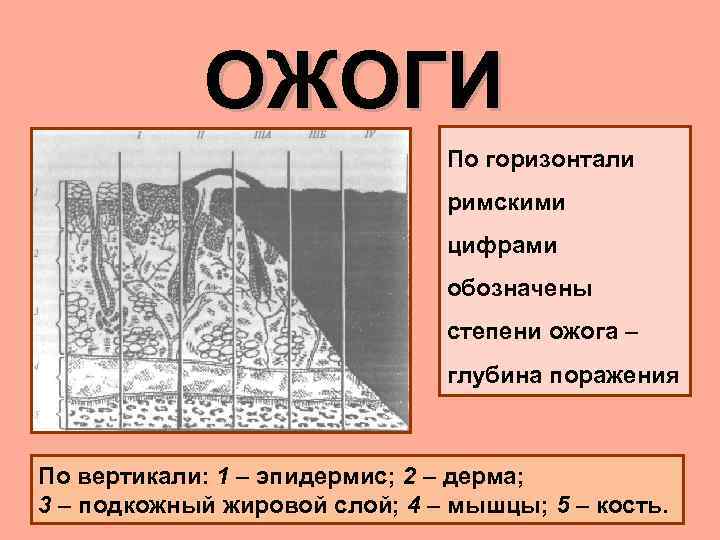 ОЖОГИ По горизонтали римскими цифрами обозначены степени ожога – глубина поражения По вертикали: 1