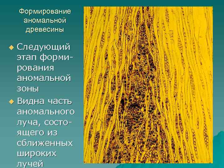 Формирование аномальной древесины Следующий этап формирования аномальной зоны u Видна часть аномального луча, состоящего