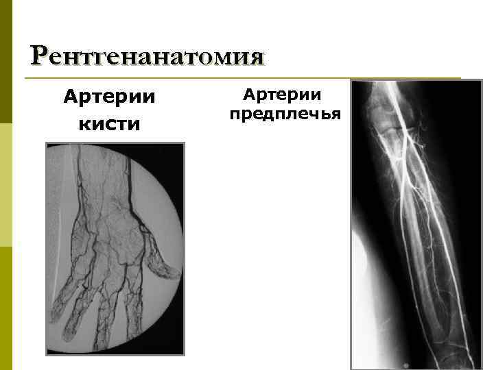 Рентгенанатомия Артерии кисти Артерии предплечья 