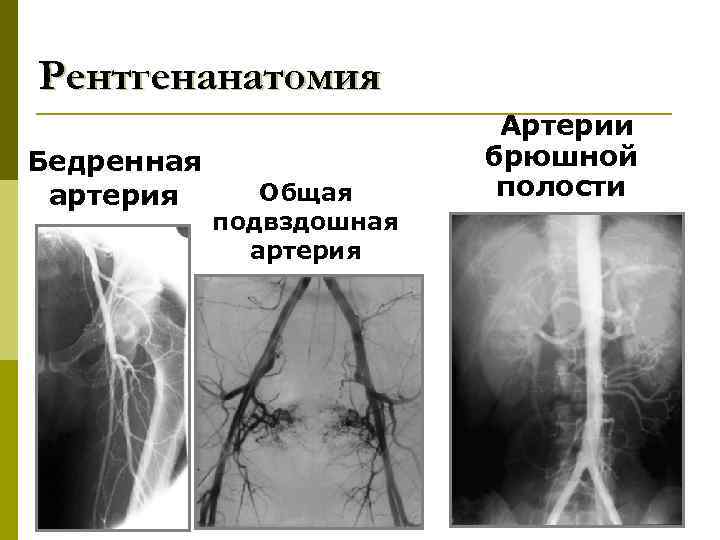 Рентгенанатомия Бедренная артерия Общая подвздошная артерия Артерии брюшной полости 