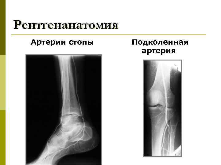 Рентгенанатомия Артерии стопы Подколенная артерия 