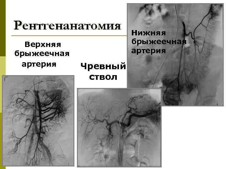 Рентгенанатомия Верхняя брыжеечная артерия Чревный ствол Нижняя брыжеечная артерия 