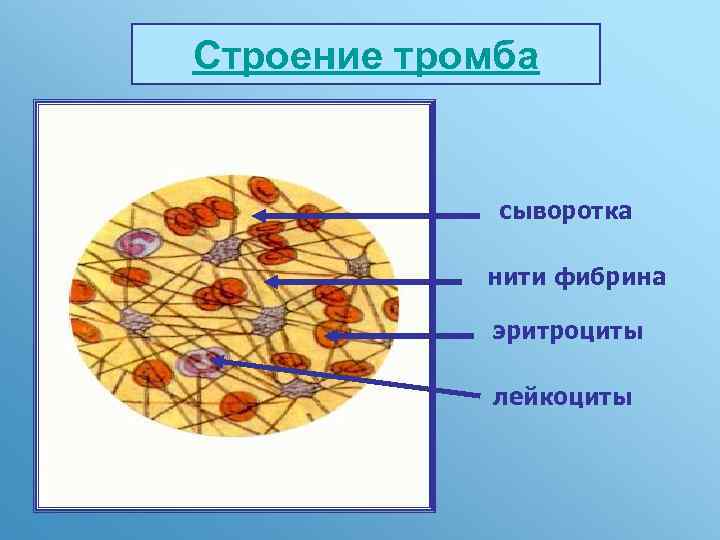 Строение тромба сыворотка нити фибрина эритроциты лейкоциты 