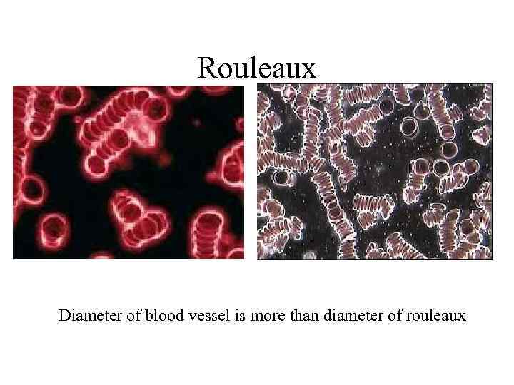 Rouleaux Diameter of blood vessel is more than diameter of rouleaux 