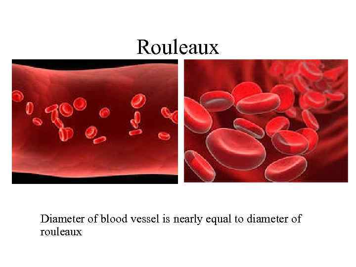 Rouleaux Diameter of blood vessel is nearly equal to diameter of rouleaux 