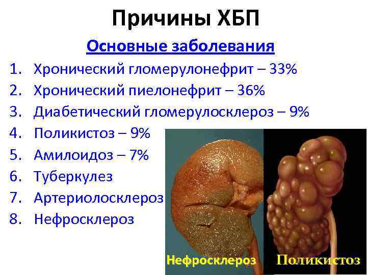  Причины ХБП Основные заболевания 1. 2. 3. 4. 5. 6. 7. 8. Хронический