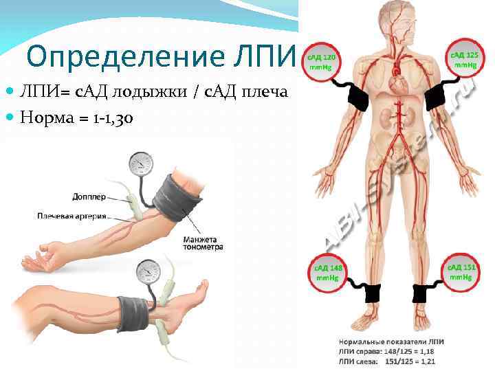 Определение ЛПИ= с. АД лодыжки / с. АД плеча Норма = 1 -1, 30