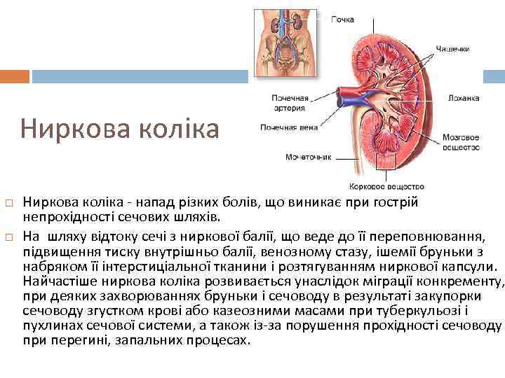 Ниркова коліка - напад різких болів, що виникає при гострій непрохідності сечових шляхів. На