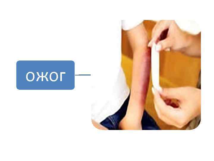 ожог 
