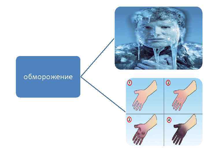обморожение 
