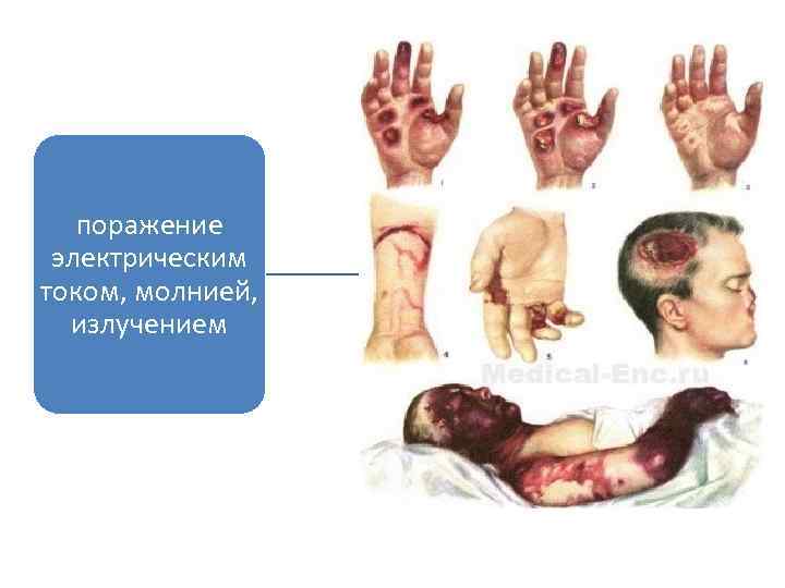 поражение электрическим током, молнией, излучением 