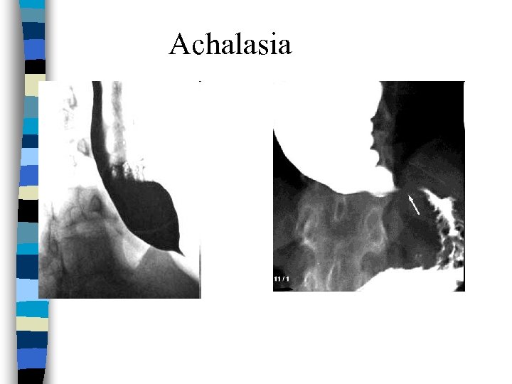 Achalasia 