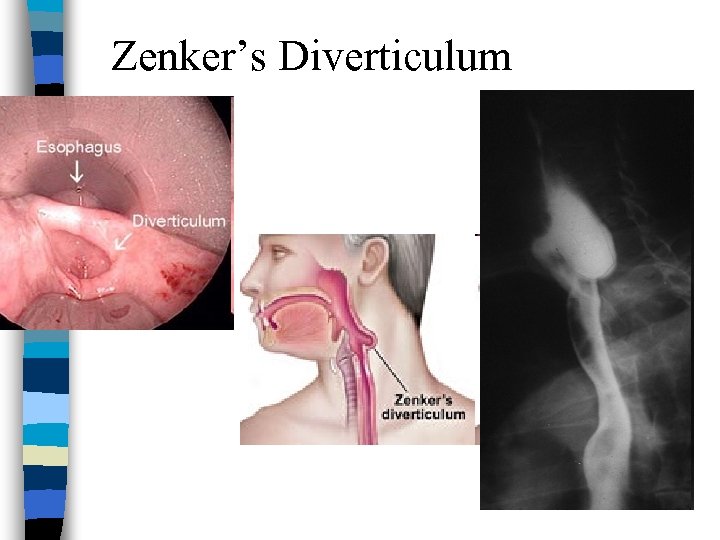 Zenker’s Diverticulum 