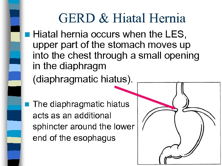 GERD & Hiatal Hernia n Hiatal hernia occurs when the LES, upper part of