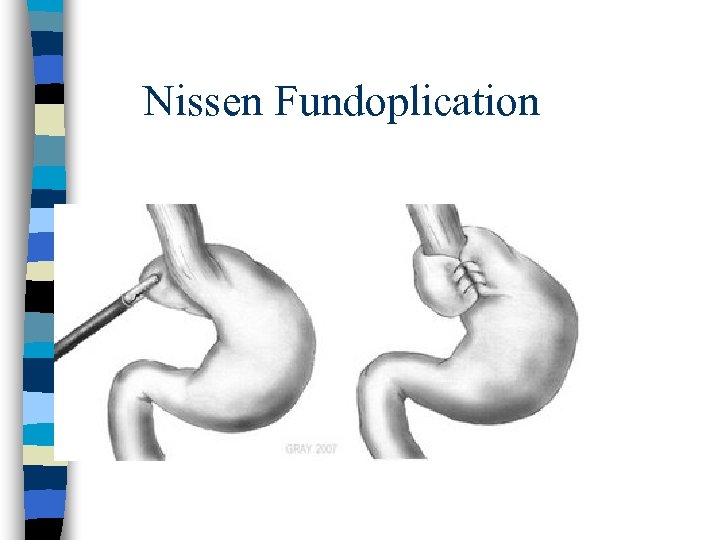 Nissen Fundoplication 