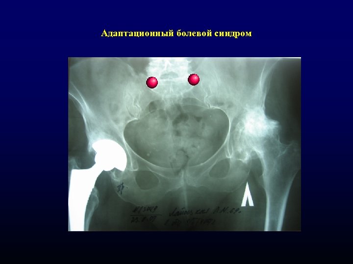 Адаптационный болевой синдром 