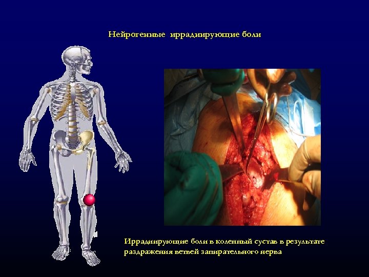 Нейрогенные иррадиирующие боли Иррадиирующие боли в коленный сустав в результате раздражения ветвей запирательного нерва